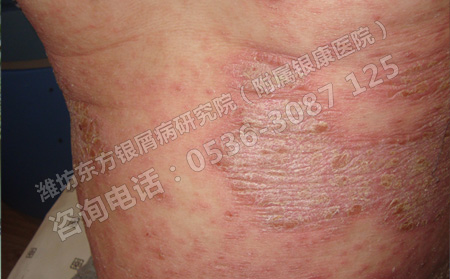 銀宵癥是什么病，怎么能好的?