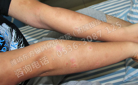 中醫在銀屑病臨床治療上的應用