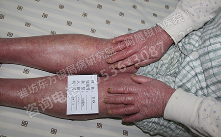 銀屑病都有哪些癥狀