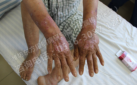 銀屑病的預(yù)防與護(hù)理