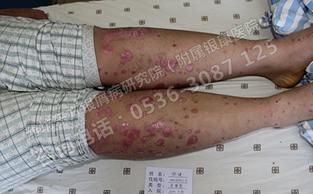 銀屑病有哪些治療常識