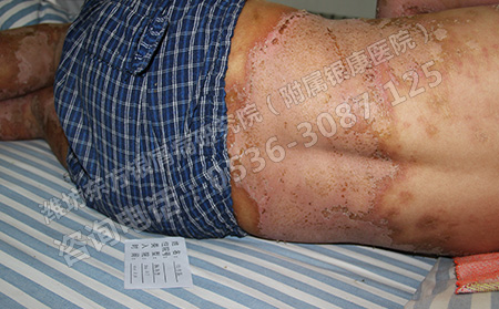 尋常型銀屑病患者的皮膚是什么樣子