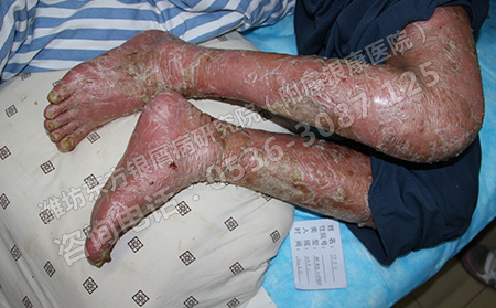 治療銀屑病忌諱那些事情?