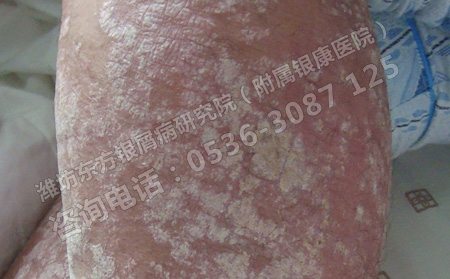 過年期間濰坊哪家醫(yī)院還治銀屑病