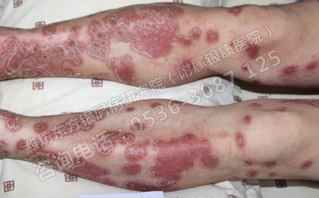 什么是膿包型銀屑病 致病原因有哪些