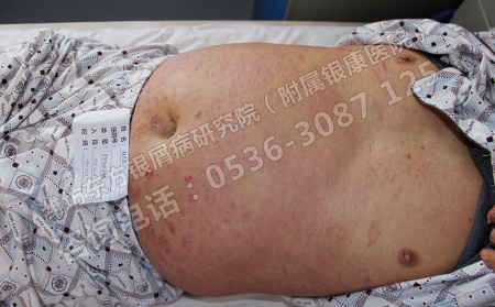 怎么治療效果好的好的銀屑病呢