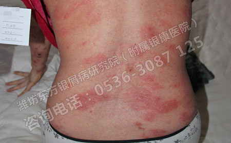 怎么治療銀屑病才能避免復發