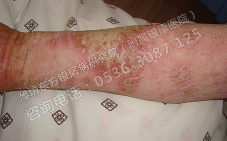 寒冷天氣如何有效的治療牛皮癬