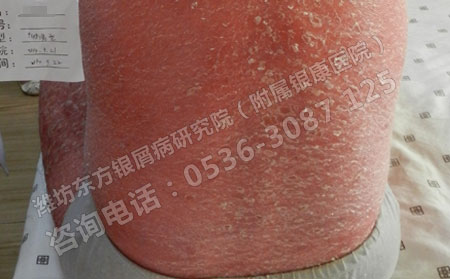 如何控制紅皮型銀屑病惡化加重