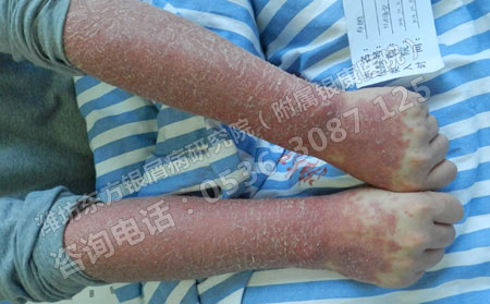 為什么有的銀屑病患者中醫治療沒有取得好的效果