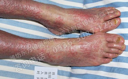 濰坊銀屑病哪家醫院非常好