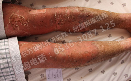 濰坊治療銀屑病檢查費用是多少