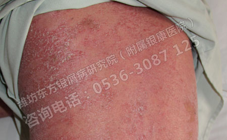 由尋常型銀屑病轉化為紅皮型患者該如何控制