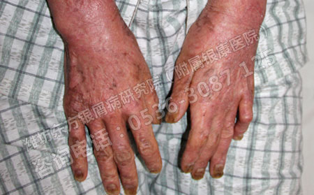 濰坊牛皮癬能好的嗎