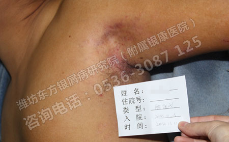 銀屑病患者平常要注意什么