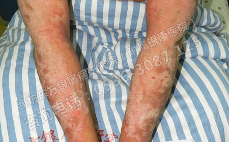 濰坊良實力的銀屑病醫(yī)院電話