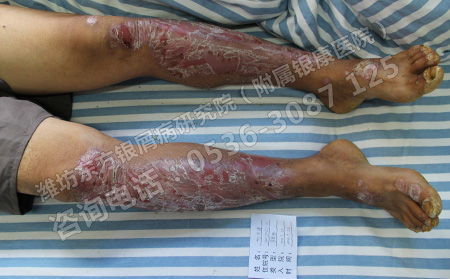 濰坊人性化銀屑病治療醫院