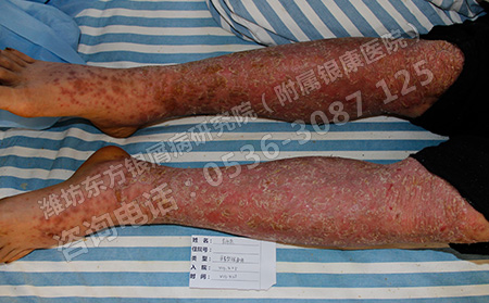 真正能治病的銀屑病醫(yī)院在哪