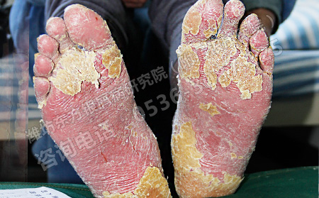 晚期銀屑病還有救嗎?可以好的嗎