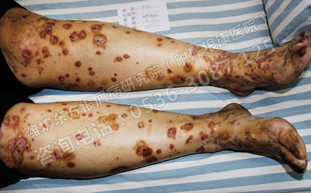 濰坊尋常型銀屑病預防的方法