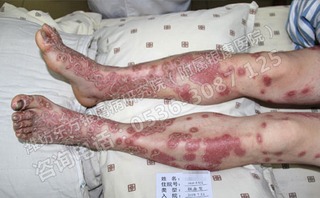 解讀銀屑病不治療會造成的哪些損害