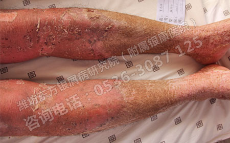 銀屑病怎么治療不加重