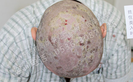 針對于老年銀屑病患者的治療要注意什么