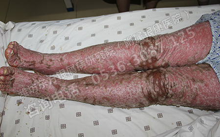 2016年哪家銀屑病醫院治療更專業