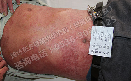 春天回歸謹(jǐn)防銀屑病隨之回歸