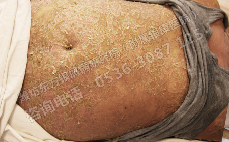 春季怎么做好離尋常型銀屑病遠(yuǎn)一點(diǎn)