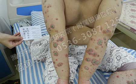 濰坊銀屑病醫院曝光五大銀屑病治療禁忌