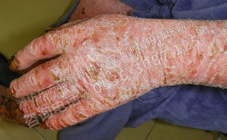 春季牛皮癬患者關(guān)節(jié)疼痛難忍怎么辦