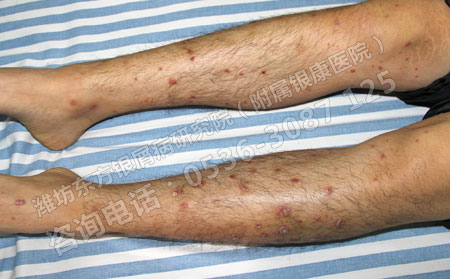 春季干癢，銀屑病患者如何防護?