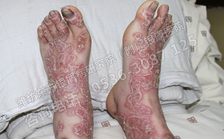 關節型銀屑病患者怎樣護理疼痛的關節?