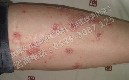 臨床上復發(fā)性尋常型牛皮癬怎么減少傷害
