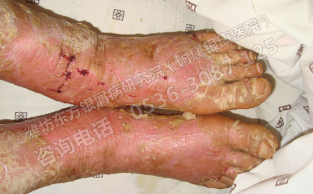 關節腫脹疼痛就是關節型牛皮癬嗎