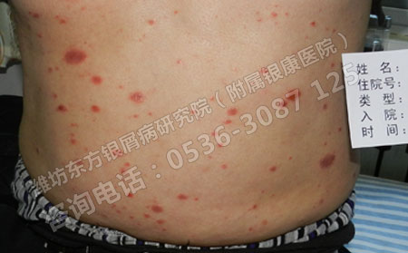 皮膚上尋常型銀屑病皮損擴散快怎么辦