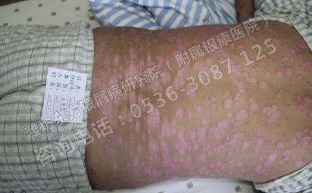 濰坊東方銀屑病醫院:治療銀屑病從飲食開始