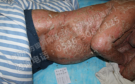 銀屑病患者的飲食護理措施