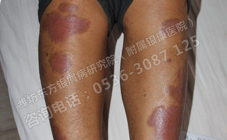 預防尋常型銀屑病需要注意什么