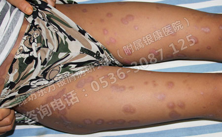 銀屑病對兒童患者會造成哪些危害