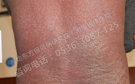 紅皮型銀屑病會(huì)對(duì)患者的身體造成什么影響