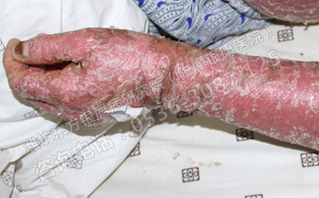 牛皮蘚春季再次復(fù)發(fā)要怎么治療