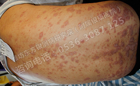 春季銀屑病患者如何預防感冒對病情的影響