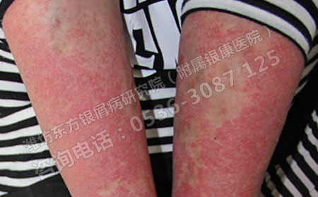 女性銀屑病患者春季復發了怎么辦