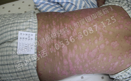 治療銀屑病有哪些需要注意的呢