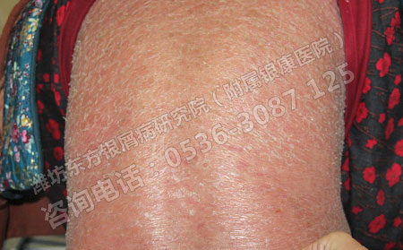 治療銀屑病，方法重要還是醫院重要?