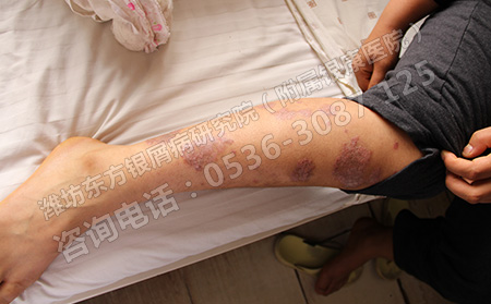 春季兒童銀屑病患者怎么預防病情加重