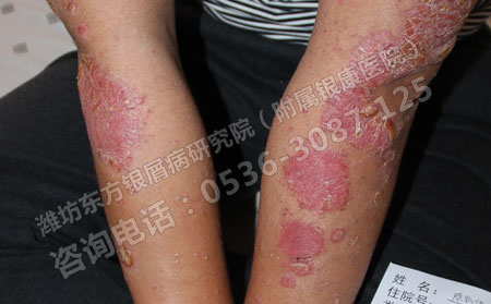 濰坊兒童得了銀屑病飲食要注意什么