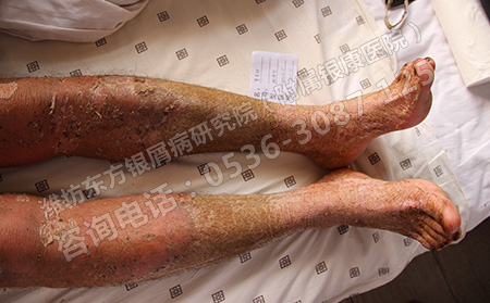 春季治療銀屑病要注意什么呢